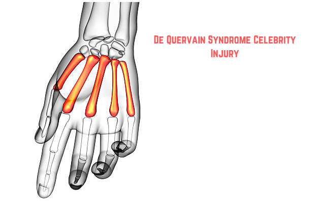 Illustration showing inflamed tendons in the wrist affected by De Quervain syndrome.